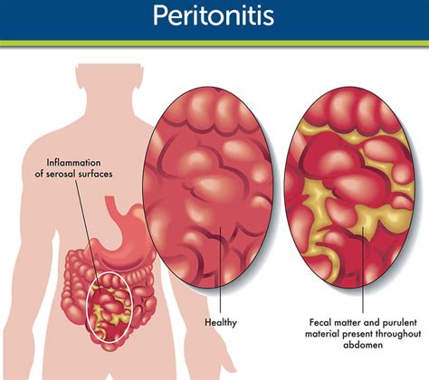 PERITONITES .